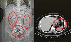 Midesinden 70 kapsül çıktı! Esenboğa Havalimanı'ndan Eskişehir'e uyuşturucu taşımışlar