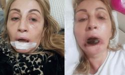 Estetik işlem sonrası dudağı çürüdü