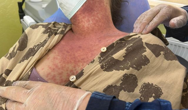 Beyazlatıcı krem faciası! Kezzap etkisi yarattı: 1'i ağır 4 yaralı