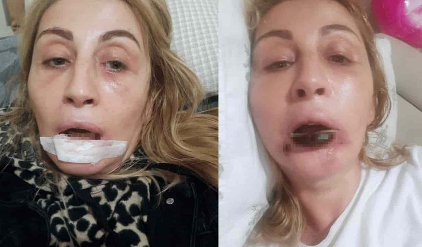 Estetik işlem sonrası dudağı çürüdü