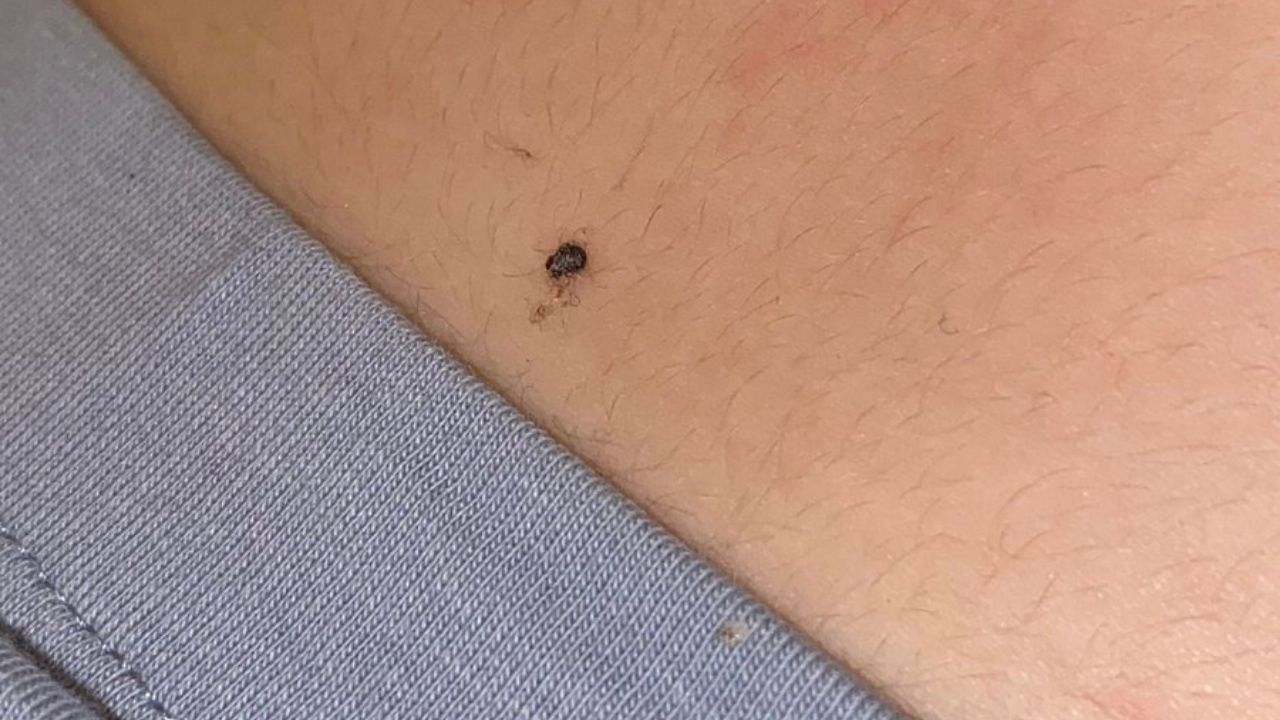Eskişehir'de Kene Paniği Büyüyor! Çocuk Parkında Görüldü