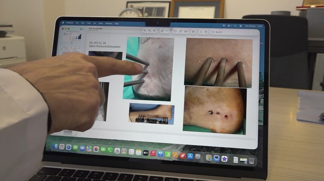 Dünyanın Ilk Enfeksiyonlu Bölgeye Uygulanabilen Yapay Kemiği Eskişehir'de Geliştirildi (3)