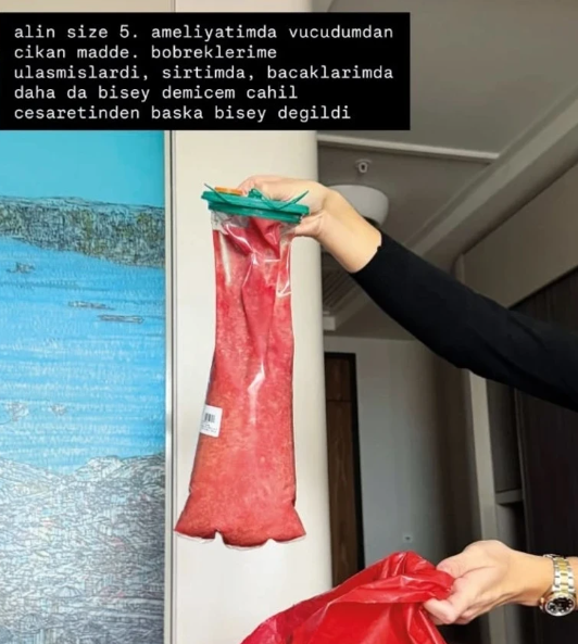 Danla Bilic Ameliyat